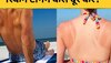 Skin Tanning: तपती धूप में घूमने के कारण त्वचा हो गई टैन? जानिए वापस कैसे लाएं निखार