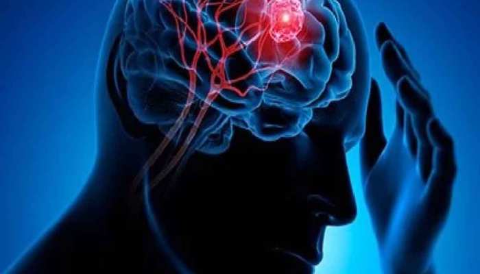 Brain Tumour: सिर्फ 60 सेकंड में पता चलेगा ब्रेन ट्यूमर है या नहीं, जानिए आसान तरीका
