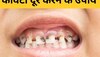 Teeth Cavity: इन 3 चीजों से मिट जाएगा दांतों की सड़न का नामोनिशान, जानिए इस्तेमाल के तरीके