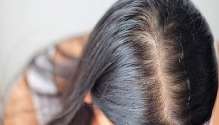 Hairfall Remedies:मानसून में बालों के झड़ने से हैं परेशान तो ये टिप्स आएंगे आपके काम