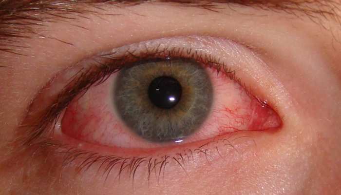 Eye Flu: क्या है पिंक और ड्राई आंखों में अंतर? जानिए कैसे करें आई फ्लू से बचाव