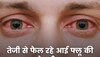 Conjunctivitis Eye Flu: बड़ों से ज्यादा बच्चों में आई फ्लू का खतरा, पैरेंट्स इस तरह रखें ध्यान