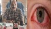 Eye Flu: हमीरपुर में बढ़ने लगे आई फ्लू के मामले, जिला स्वास्थ्य विभाग ने जारी किए निर्देश