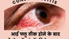 Conjunctivitis Eye Flu: आई फ्लू ठीक होने के बाद भी आंखों को पहुंच सकता है नुकसान! ये लापरवाही बरतना पड़ेगा महंगा