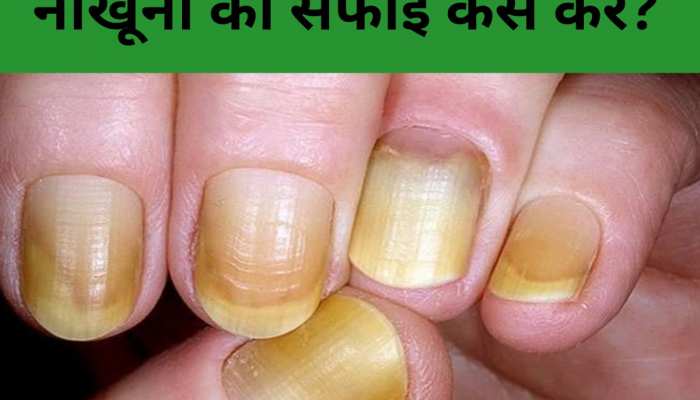 नाखून (Nails) से बीमारियों का कैसे पता लगायें| – Astrogurukul