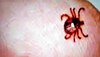 Nahan News: हिमाचल के नाहन में स्क्रब टाइफस व डेंगू के मामले बढ़े, CMO ने टैस्टिंग के दिए आदेश