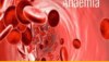 Anemia: दुनिया का हर चौथा शख्स इस बीमारी से प्रभावित, आज ही जानें लक्षण और बचाव का तरीका