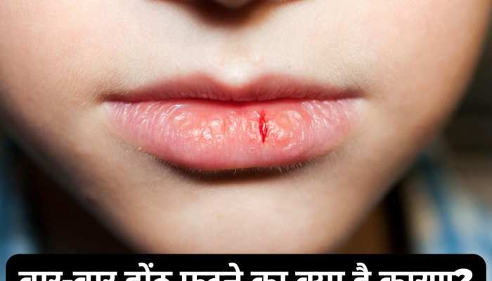 Cracked Lips: बार-बार होंठ फटने का क्या है कारण? कहीं इन बीमारियां का खतरा तो नहीं