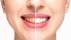 Natural Teeth Whitening: दांतों से पीलापन हटाएंगे ये 5 घरेलू उपाय, मोती की तरह चमकने लगेंगे आपके दांत