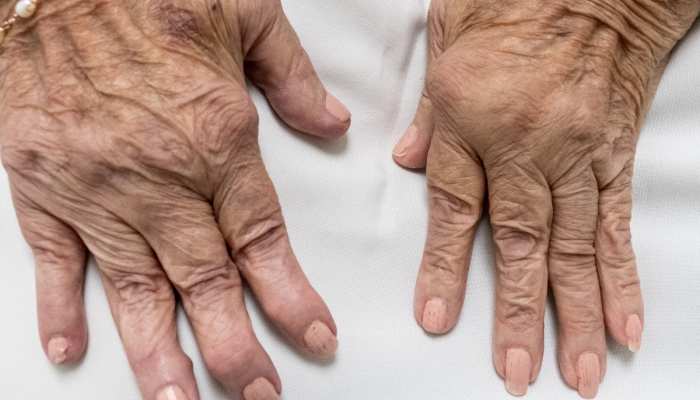 Arthritis: गठिया के दर्द को दूर करेगी ये खास तरह की रोटी, यूरिक एसिड लेवल भी होगा कम