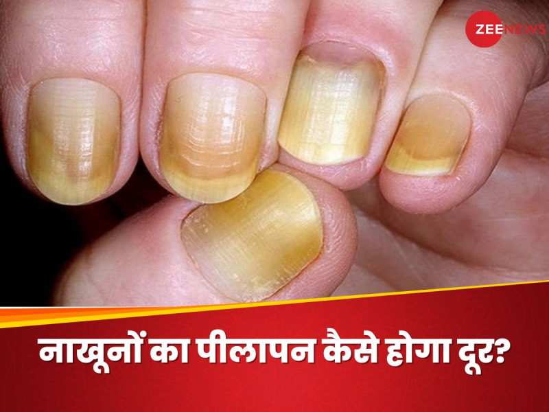 nails tell health problems Archives - Grihshobha