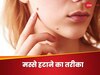 Warts: किचन के इस मसाले की मदद से गायब होंगे मस्से, जानिए इस्तेमाल करने का तरीका