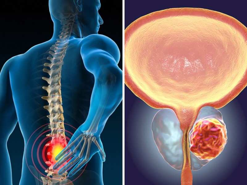 Prostate Cancer की शुरुआत हैं इस हिस्से में दर्द समेत ये 4 लक्षण, तुरंत कराएं जांच