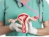  cervical cancer 