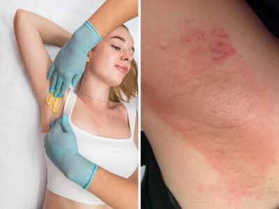 Wax Burn जल्दी कैसे ठीक करें? वैक्सिंग के दौरान जलने पर इन आसान उपायों से पाएं राहत