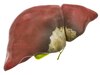 Fatty Liver: सिर्फ शराब ही नहीं, मीठा भी बढ़ा सकता है फैटी लिवर का खतरा, कैसे कम करें रिस्क?