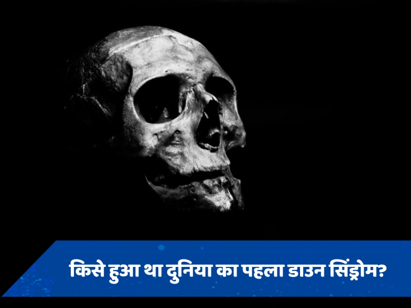 किसे हुआ था दुनिया का पहला डाउन सिंड्रोम? 14 लाख साल पुरानी खोपड़ी से वैज्ञानिकों ने खोज निकाला