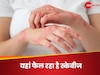 Scabies: इस देश में खाज बीमारी ने उड़ा दी है डॉक्टरों की नींद, तेजी से हो रहा आउटब्रेक