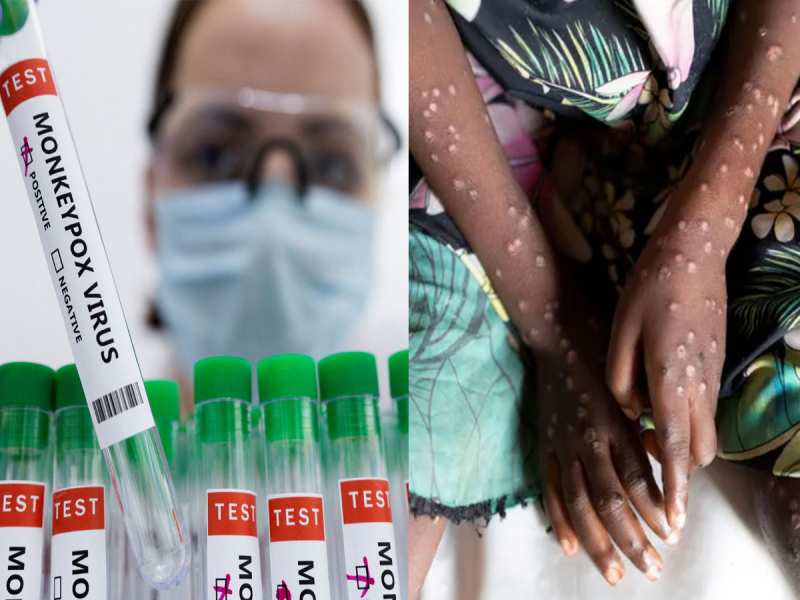 केरल में Mpox ने फिर दी दस्तक, UAE से लौटे 2 लोगों में मिला संक्रमण, राज्य मे अलर्ट