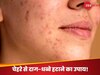Rose Water for Face: चेहरे के दाग-धब्बों से डगमगा गया है आत्मविश्वास? गुलाब जल में मिला लें ये 3 चीजें, सारा कालापन हो जाएगा दूर!