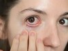 Dry Eyes Disease: डिजिटल दुनिया का बढ़ता हुआ खतरा, डॉक्टर से जाने बचाव का तरीका
