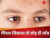 चेहरे पर आए 'मोटे-मोटे पिंपल' तो शख्स ने छोड़ दी नौकरी, बोला- हेल्थ से कोई मजाक नहीं...
