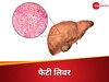 Fatty Liver: फैटी लिवर की बीमारी कितनी खतरनाक है? जानिए स्टेज 1 से स्टेज 4 तक का फर्क