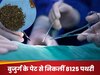 एक घंटे के ऑपरेशन में निकलीं 8125 पथरियां; गिनने में लगे 6 घंटे, डॉक्टरों ने देखा ऐसा मंजर कि...