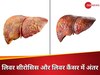 लिवर सीरोसिस और लिवर कैंसर को एक समझने की न करें गलती, 5 प्वाइंस्ट में जानें दोनों में अंतर