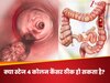 क्या चौथी स्टेज का कोलन कैंसर भी हो सकता है ठीक? जानें कितने प्रतिशत रह जाती है जीने की संभावना!