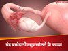 बिना चीरफाड़ किए खुल सकती है बच्चेदानी की बंद ट्यूब, जानें फैलोपियन ट्यूब खोलने का असरदार उपाय!