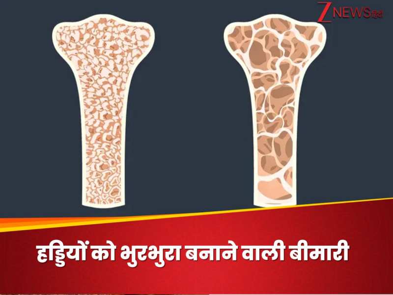 हड्डियों को अंदर से कमजोर कर भुरभुरा बना देती है ये बीमारी, खत्म हो जाती है ताकत