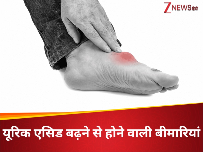 गठिया ही नहीं, यूरिक एसिड बढ़ने पर ये खतरनाक बीमारियां भी हो जाती हैं सुपर एक्टिव