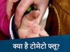 MP में टोमैटो फ्लू ने बढ़ाई लोगों की चिंता