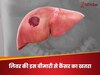 लिवर का रखें ख्याल, वरना इस परेशानी से बढ़ेगा कैंसर का रिस्क, एम्स के डॉक्टर ने चेताया