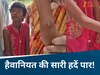 minor girl hand burnt in chhindwara due to religious thread on her wrist