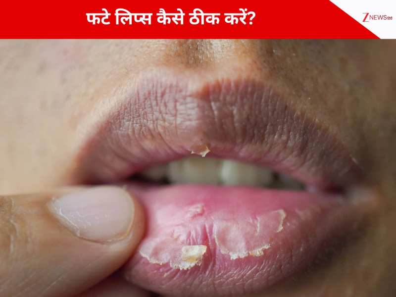 ठंडी हवा से फट रहे हैं होंठ, इन घरेलू उपाय से लिप्स हो जाएंगे गुलाबी और सॉफ्ट!