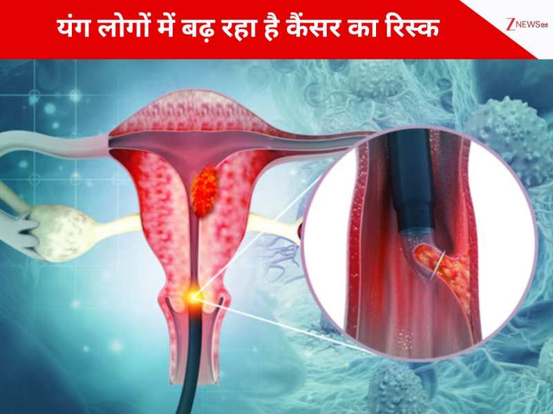 30 साल की उम्र में हो सकता है कैंसर, HPV की वजह से यंग लोगों में बढ़ रहा है रिस्क